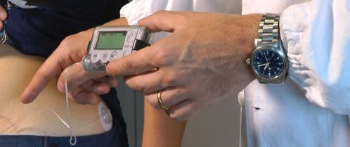 Buzzy® e l'Impianto microinfusore insulinico