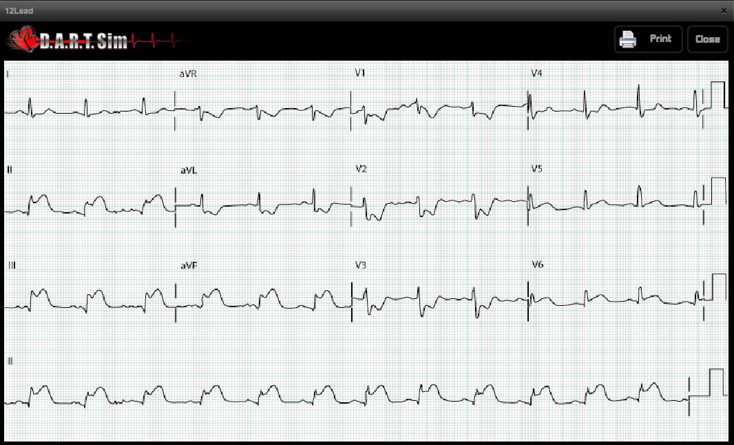 ECG Simulator