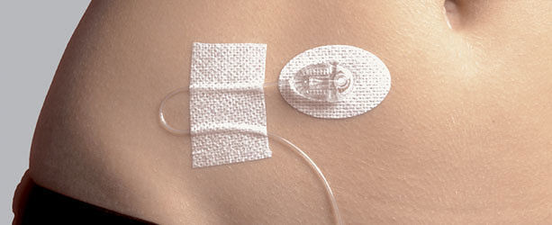 Buzzy® e l'Impianto microinfusore insulinico